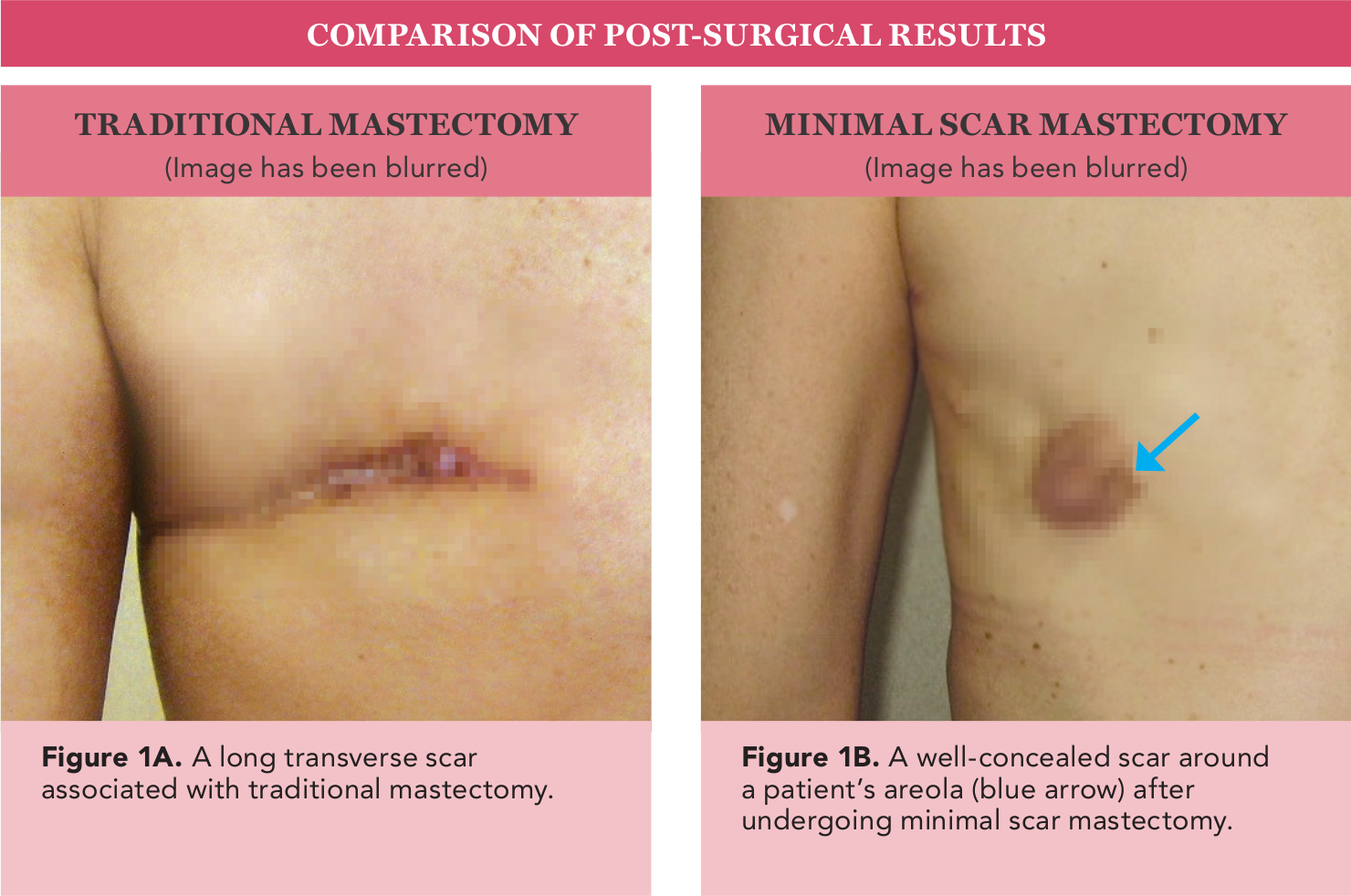 Mastectomy Mastectomy Recovery:
